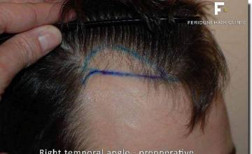 Hair restoration procedure results