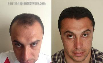 Before and after hair transplantation result photographs