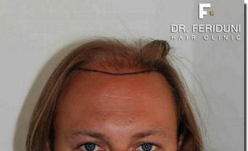 Hair restoration procedure results