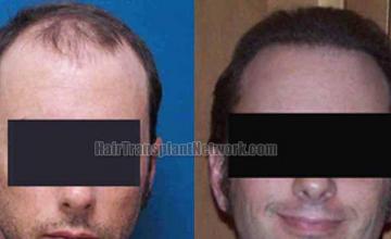 Hair transplantation surgery before and after photos