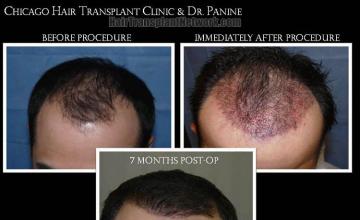 Hair restoration procedure before and after results