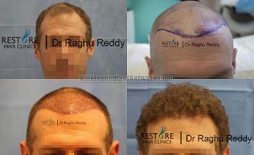 Before and after hair transplant procedure images