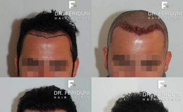 Before and after hair transplant procedure images