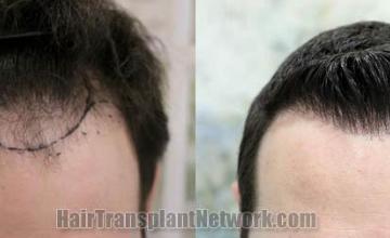 Hair restoration procedure before and after pictures