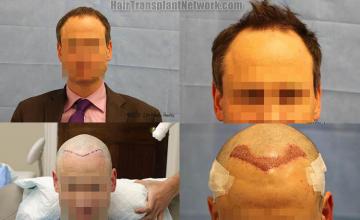 Hair transplantation surgery before and after images