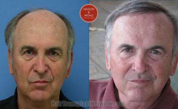 Hair restoration procedure before and after results