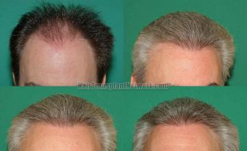 Hair restoration procedure before and after results