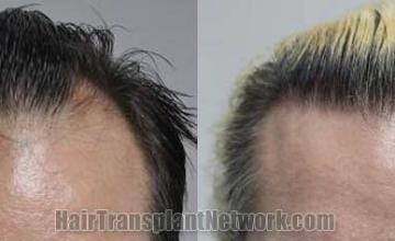 Hair transplantation surgery before and after pictures