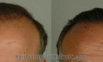 Before and after hair transplant procedure images