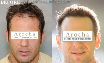 Hair restoration procedure before and after results