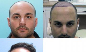 Hair restoration procedure before and after results