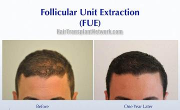 Hair restoration procedure before and after results