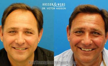 Hair restoration procedure before and after results