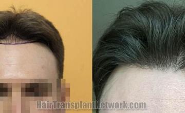 Before and after hair transplant procedure images