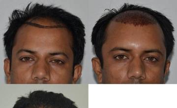 Before and after hair transplant procedure images