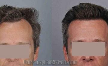 Hair transplantation surgery before and after images