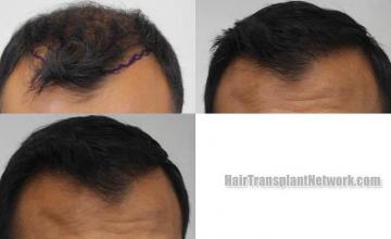 Hair restoration procedure before and after results