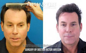 Front view - Before and after hair restoration procedure