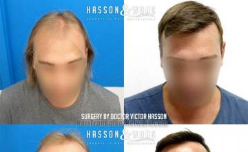 Front view - Before and after hair restoration procedure