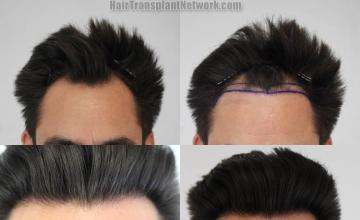 Front view - Before and after hair restoration procedure