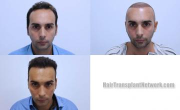 Front view - Before and after hair restoration procedure