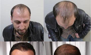 Hair restoration procedure before and after pictures