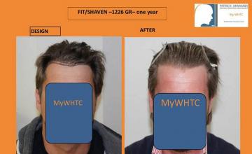 Hair transplantation surgery before and after photos