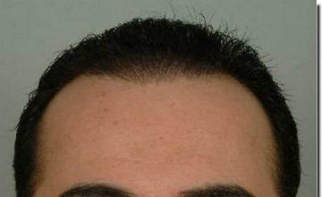 Hair restoration procedure results