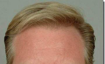 Hair restoration procedure results