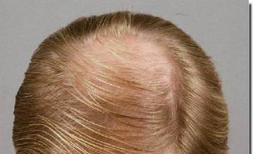 Hair restoration procedure results