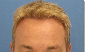 Hair restoration procedure results