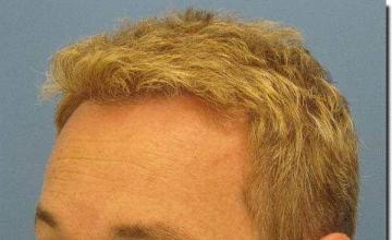 Hair restoration procedure results