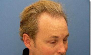 Hair restoration procedure results