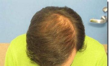 Hair restoration procedure results