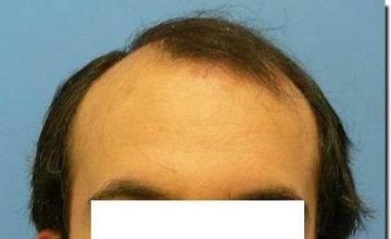 Hair restoration procedure results