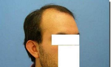 Hair restoration procedure results