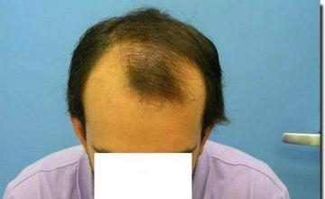 Hair restoration procedure results