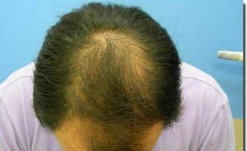 Hair restoration procedure results