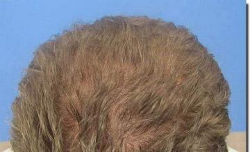 Hair restoration procedure results