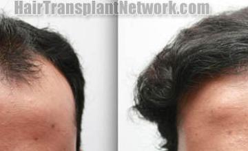 Hair restoration procedure before and after results