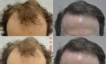 Hair transplantation surgery before and after images