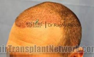 Hair transplantation surgery before and after images