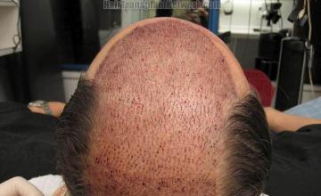 Hair restoration surgery before and after photos