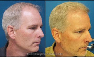 Hair transplantation surgery before and after pictures