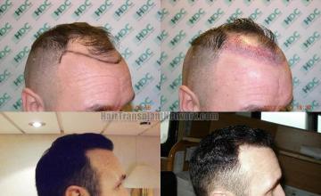 Hair transplantation surgery before and after images