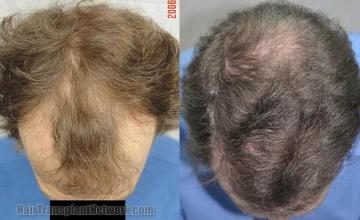 Hair restoration procedure before and after results