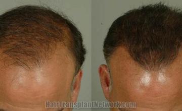 Hair restoration surgery before and after images