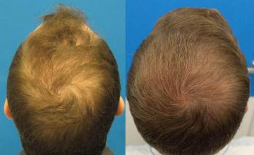 Back view before and after hair transplantation photos