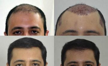 Hair restoration procedure before and after results