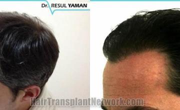 Hair transplant surgery before and after photos